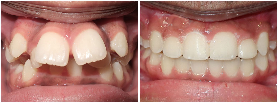 before and after