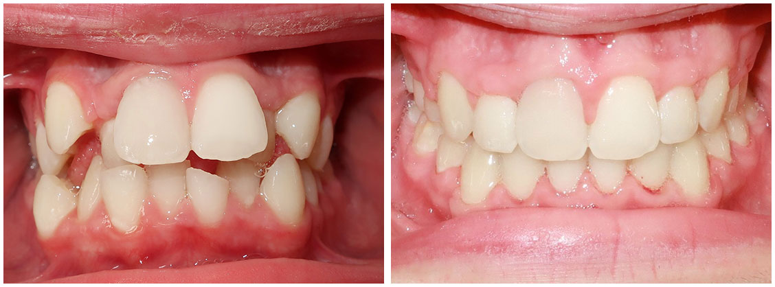 before and after