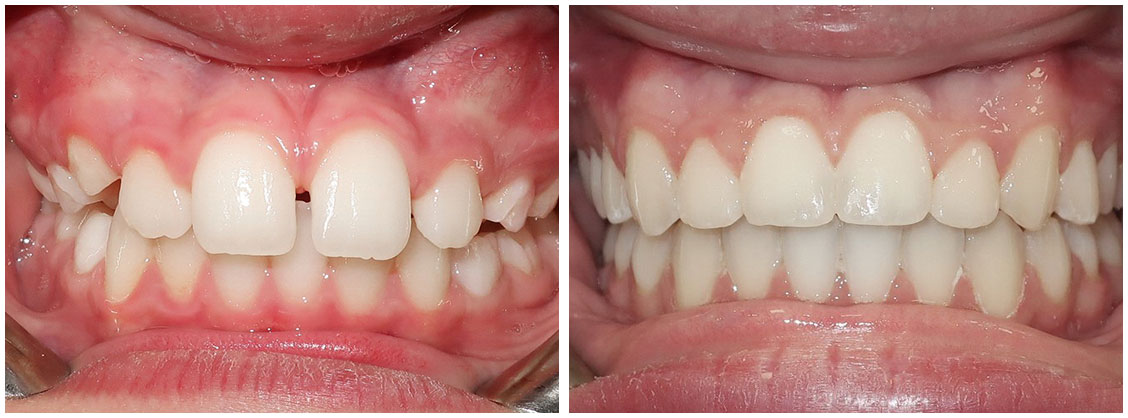 before and after