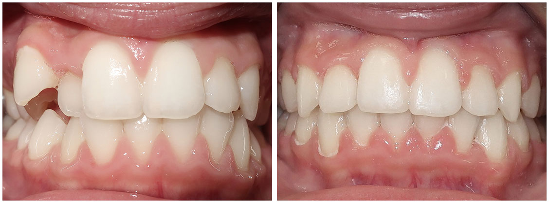before and after