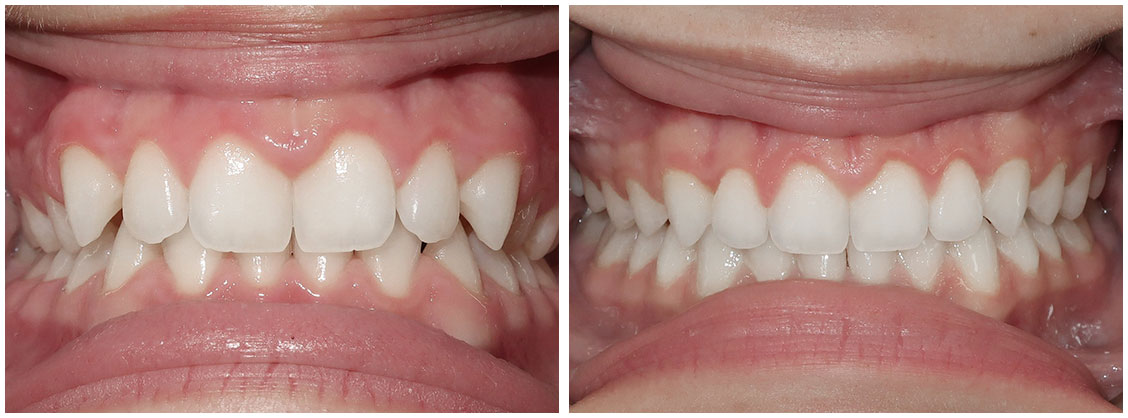 before and after